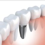 Czy implanty stomatologiczne są bezpieczne dla zdrowia?