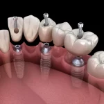 Implanty zębów cała szczęka cena Szczecin