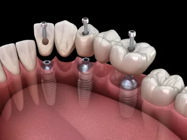 Implanty zębów cała szczęka cena Szczecin