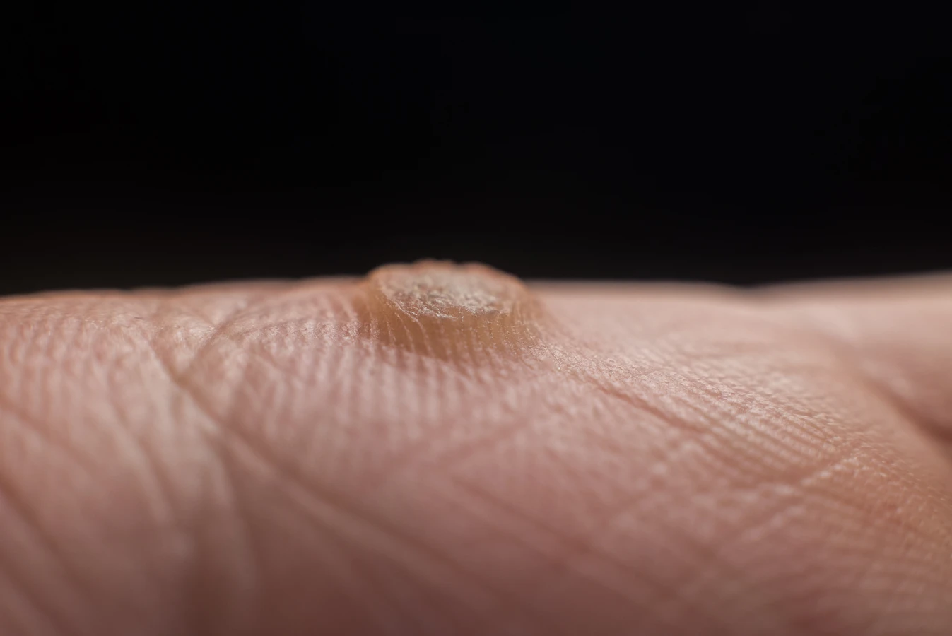 Co na kurzajki w ciąży?